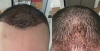 Hair Transplant Melbourne