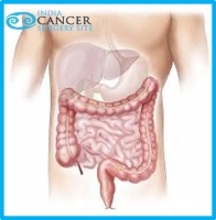 Top Colon Cancer Treatment Hospital of India