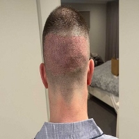 Hair Transplant Melbourne