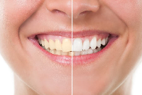 Zoom Teeth Whitening Parramatta