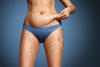 Liposuction in Lahore