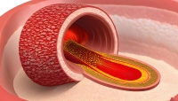 Atherosclerosis