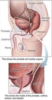 WHAT ARE THE RISKS OF FAMILY HISTORY OF PROSTATE CANCER ICD 10?