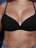 Best Breast Implants San Bruno