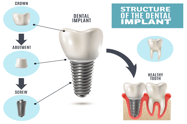 Dental Implants Cost: Dental Implants Prescott AZ