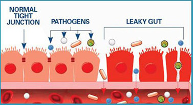 How can I find a doctor qualified to treat leaky gut syndrome?