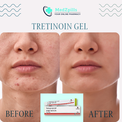 Retinoids for Younger-Looking Skin: Tretinoin Gel Boosts Collagen Production