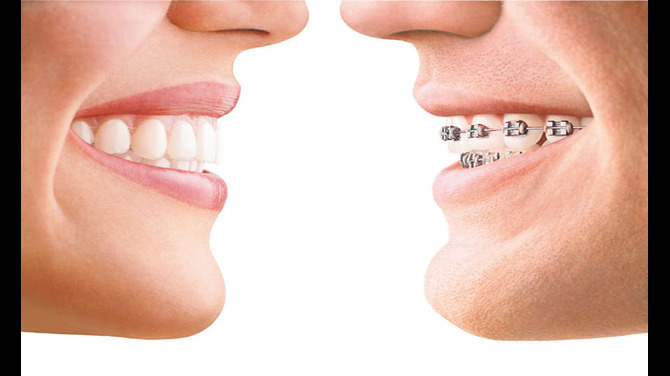 Transforming Smiles One Align at a Time