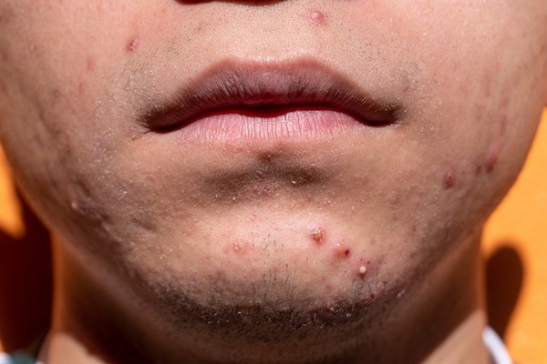 The Science of Clear Skin: Unraveling the Best Acne Treatments