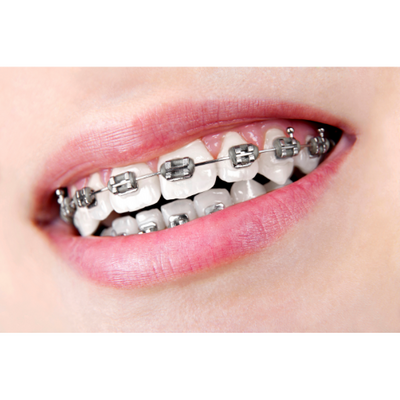 Pros and Cons of Different Types of Braces