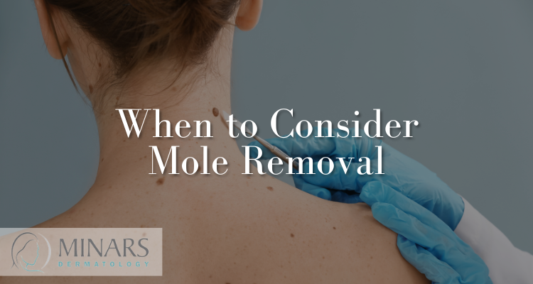 When to Consider Mole Removal