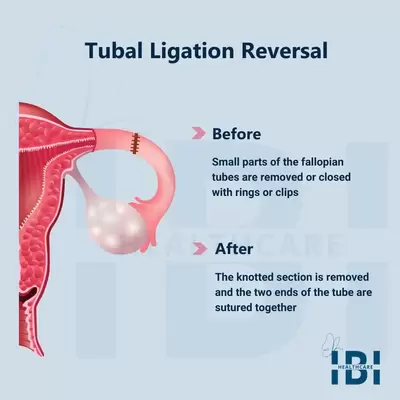 Can You Do IVF After Tubal Ligation?