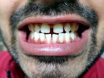 PICK THE APPROPRIATE DENTAL TREATMENT FOR YOUR GAPPED TEETH