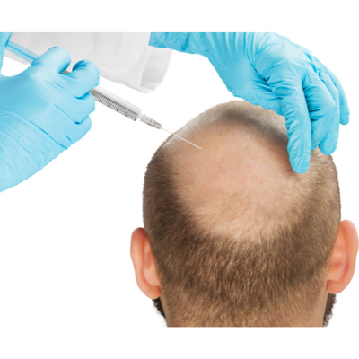 PRP Hair Loss Therapy: Everything You Need to Know